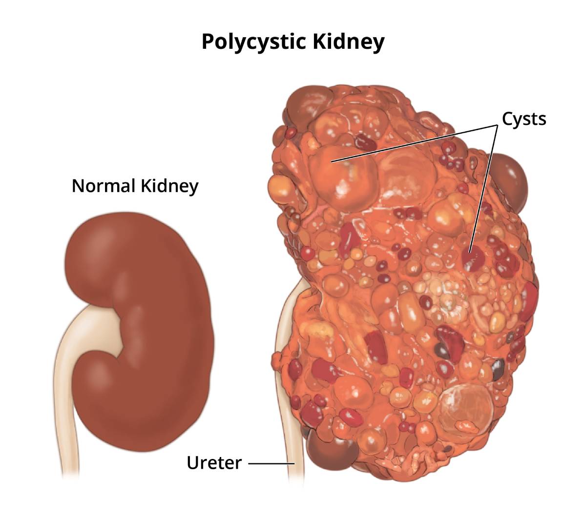 Illustration comparing a normal kidney with a polycystic kidney. The polycystic kidney is enlarged and covered in cysts of many sizes. The ureter is labeled.